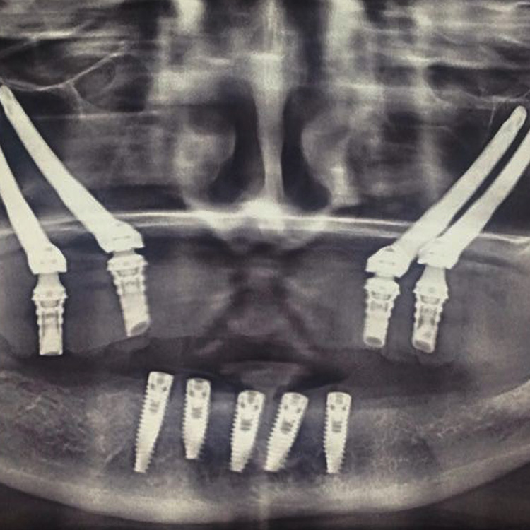 Implantes Cigomáticos Colombia