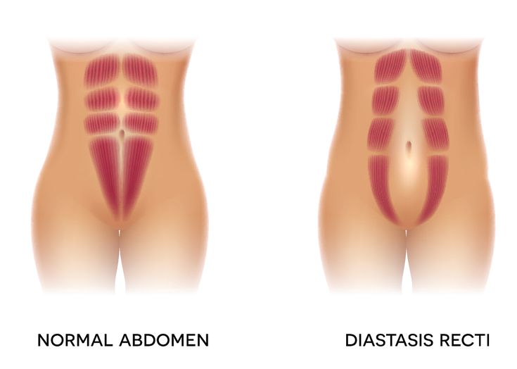 diastasis recti